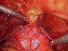 The scope transmits laparoscopic radical prostatectomy images.