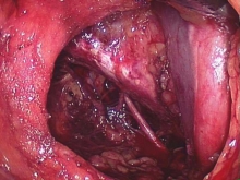 after removal of the external iliac pelvic lymph nodes